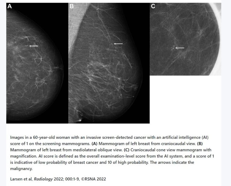 How Mammography AI Used In Breast Cancer Screening And Diagnosis